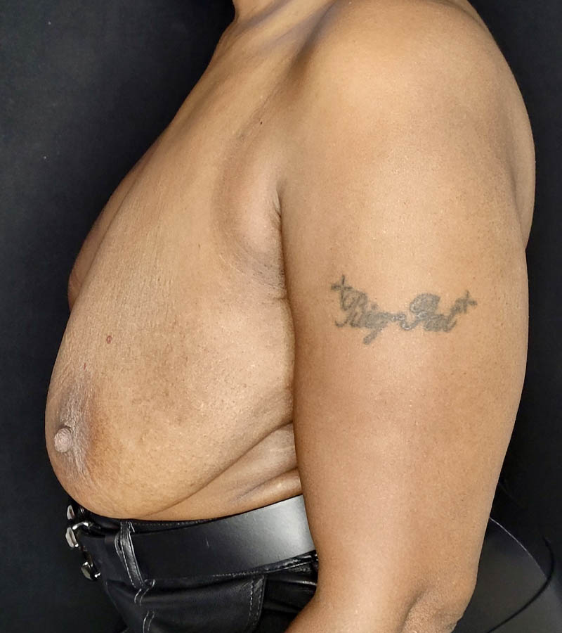 Breast Revision case #4792