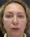 Blepharoplasty case #4821