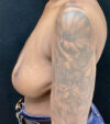 Breast Revision case #4792