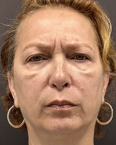 Blepharoplasty case #4821