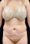 Tummy Tuck case #4722