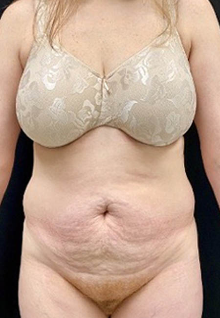 Tummy Tuck case #4722