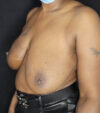 Breast Revision case #4792