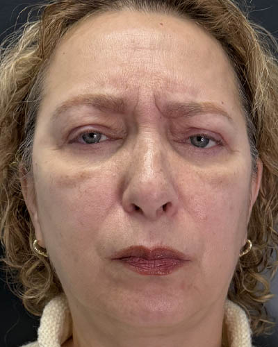 Blepharoplasty case #4821