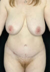 Tummy Tuck case #4722
