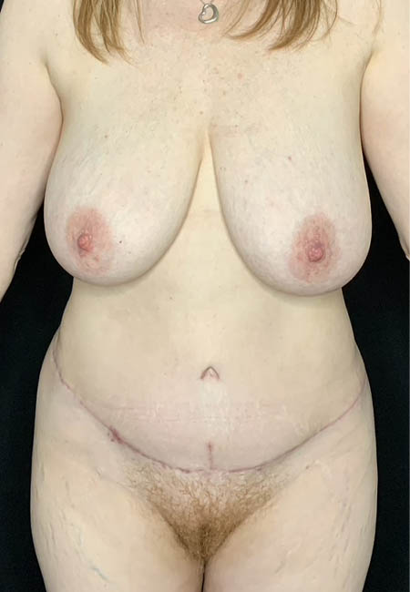 Tummy Tuck case #4722