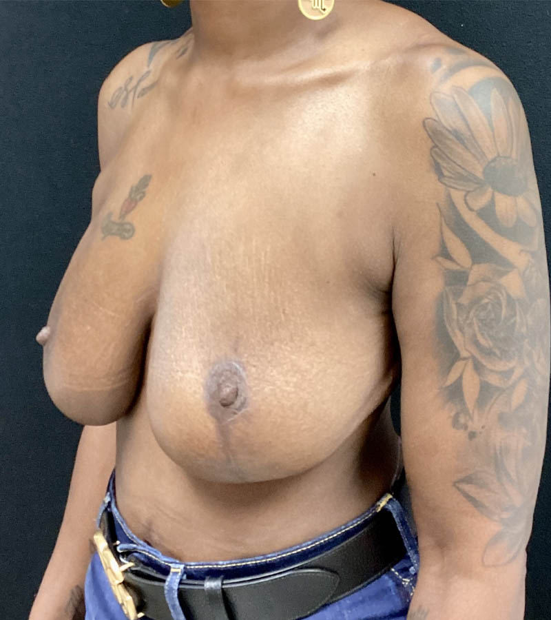 Breast Revision case #4792
