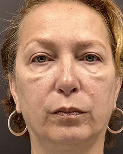 Blepharoplasty case #4821