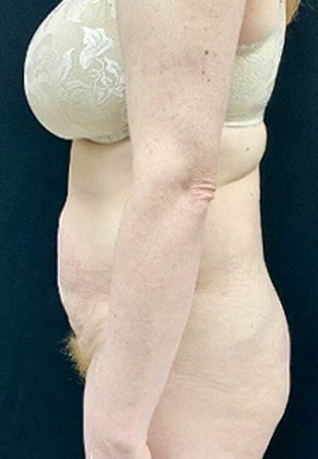 Tummy Tuck case #4722