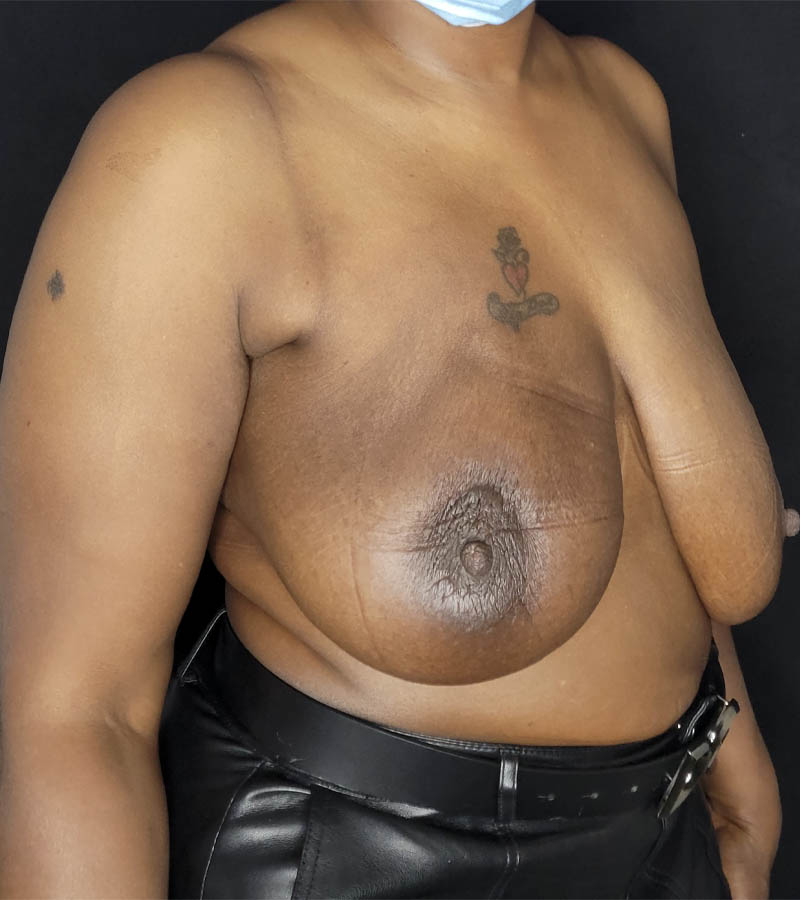 Breast Revision case #4792