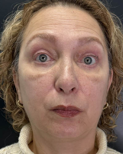 Blepharoplasty case #4821
