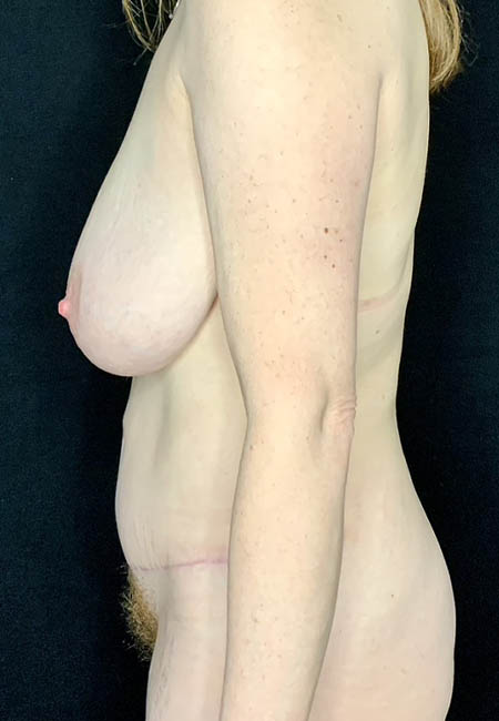 Tummy Tuck case #4722
