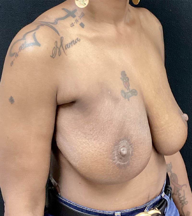 Breast Revision case #4792