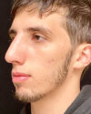 Rhinoplasty case #4896