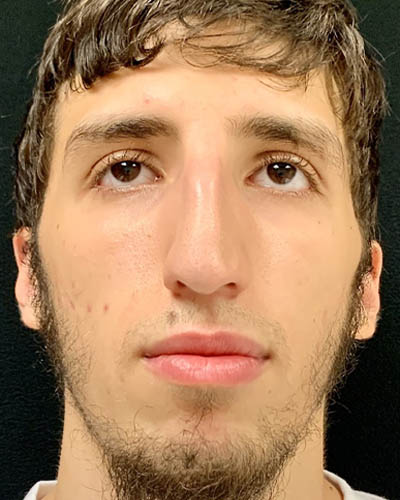 Rhinoplasty case #4896