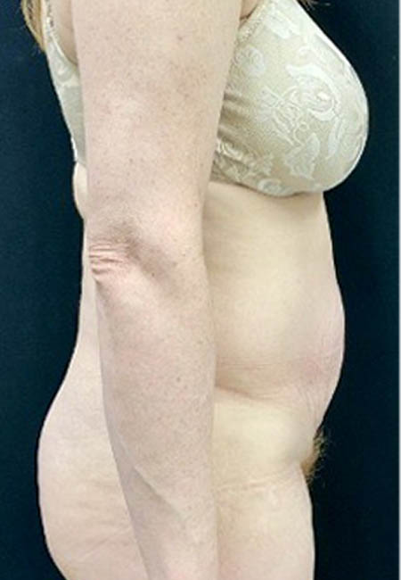 Tummy Tuck case #4722