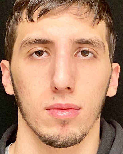 Rhinoplasty case #4896