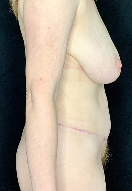 Tummy Tuck case #4722