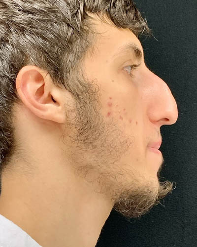 Rhinoplasty case #4896