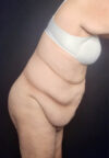 Tummy Tuck case #4733