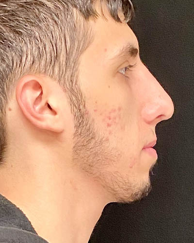 Rhinoplasty case #4896