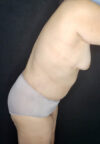 Tummy Tuck case #4733