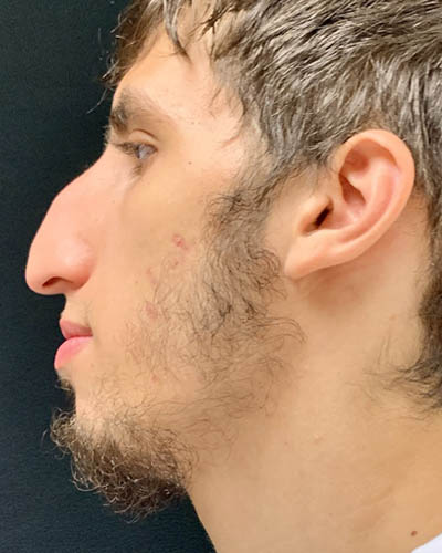 Rhinoplasty case #4896