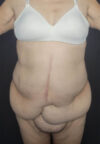 Tummy Tuck case #4733
