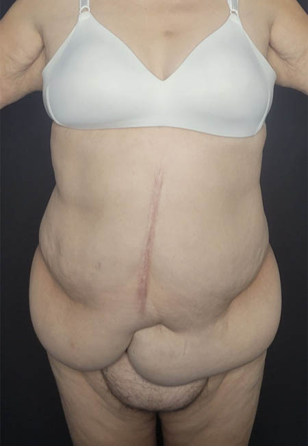 Tummy Tuck case #4733