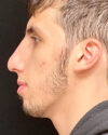 Rhinoplasty case #4896