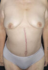 Tummy Tuck case #4733