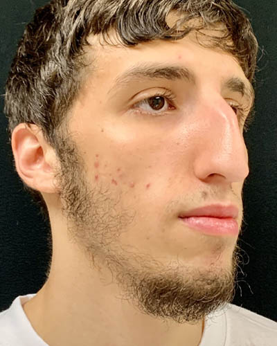 Rhinoplasty case #4896