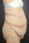 Tummy Tuck case #4733