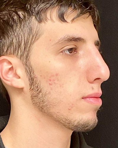 Rhinoplasty case #4896