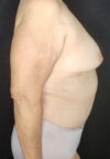 Tummy Tuck case #4733