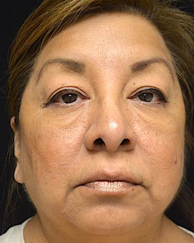 Blepharoplasty case #4840