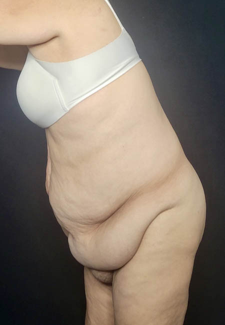 Tummy Tuck case #4733