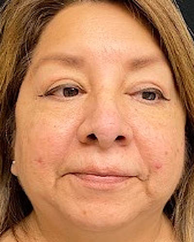 Blepharoplasty case #4840