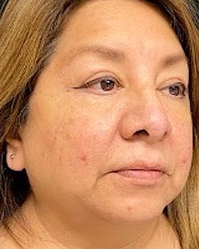 Blepharoplasty case #4840