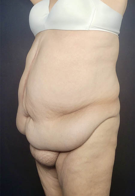 Tummy Tuck case #4733