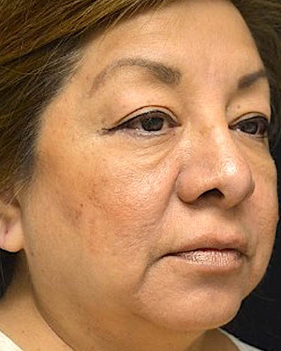Blepharoplasty case #4840