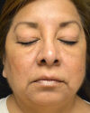 Blepharoplasty case #4840