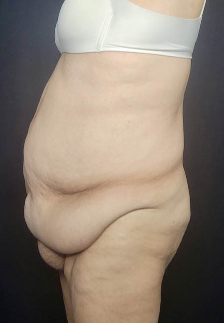 Tummy Tuck case #4733