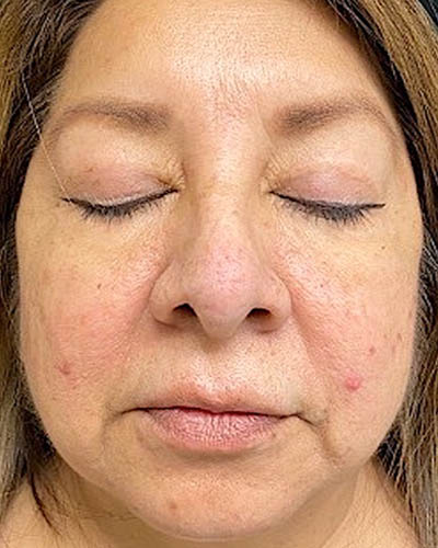 Blepharoplasty case #4840