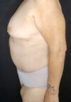 Tummy Tuck case #4733