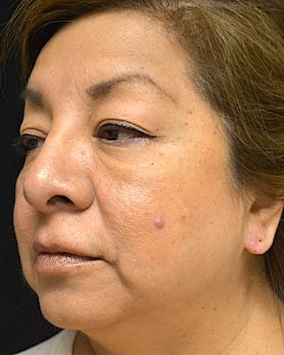 Blepharoplasty case #4840