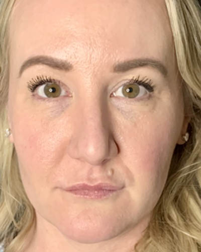 Blepharoplasty case #4849
