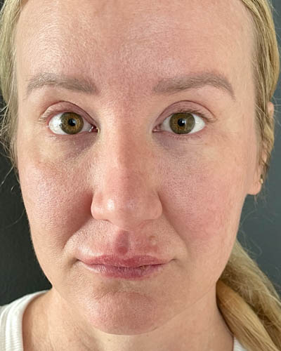 Blepharoplasty case #4849