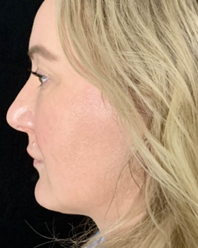 Blepharoplasty case #4849