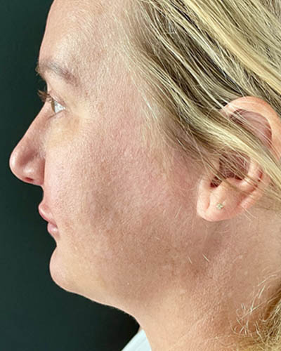 Blepharoplasty case #4849